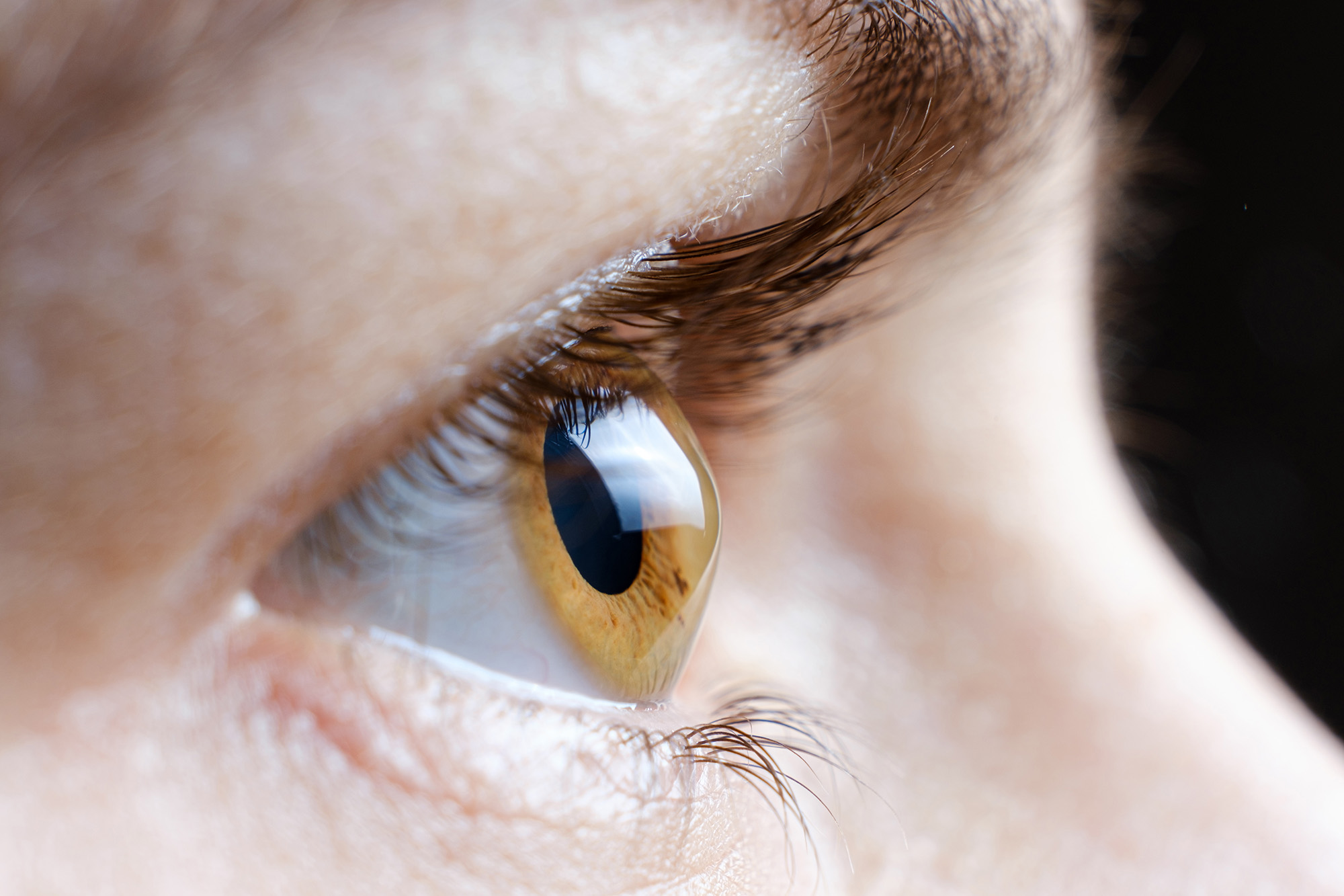 Auge mit Hornhaut als Keratokonus